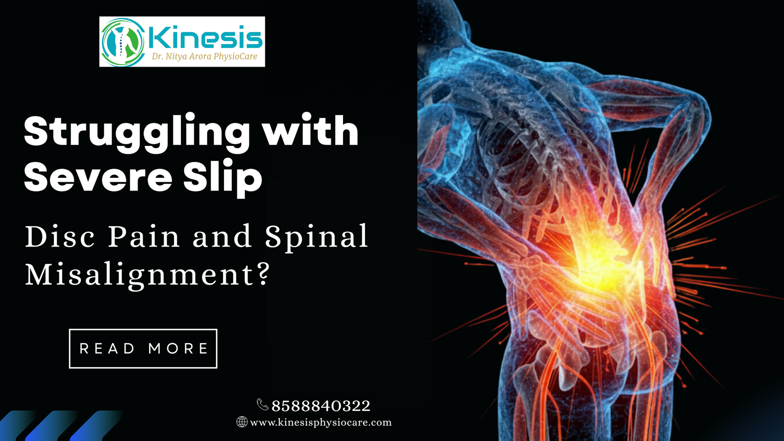 Struggling with Severe Slip Disc Pain and Spinal Misalignment?